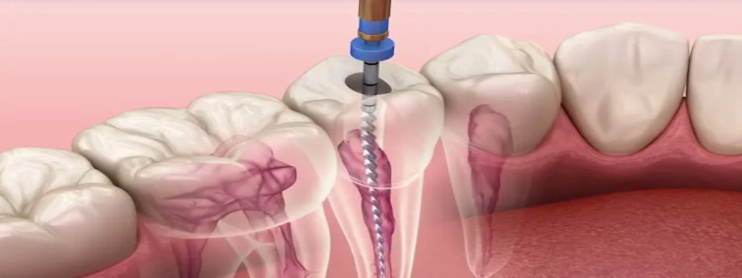 Endodoncia