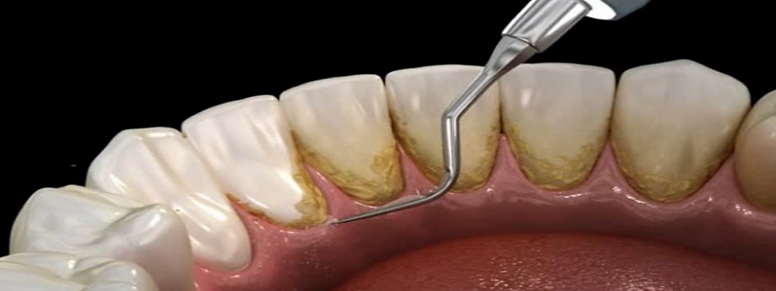 periodoncia